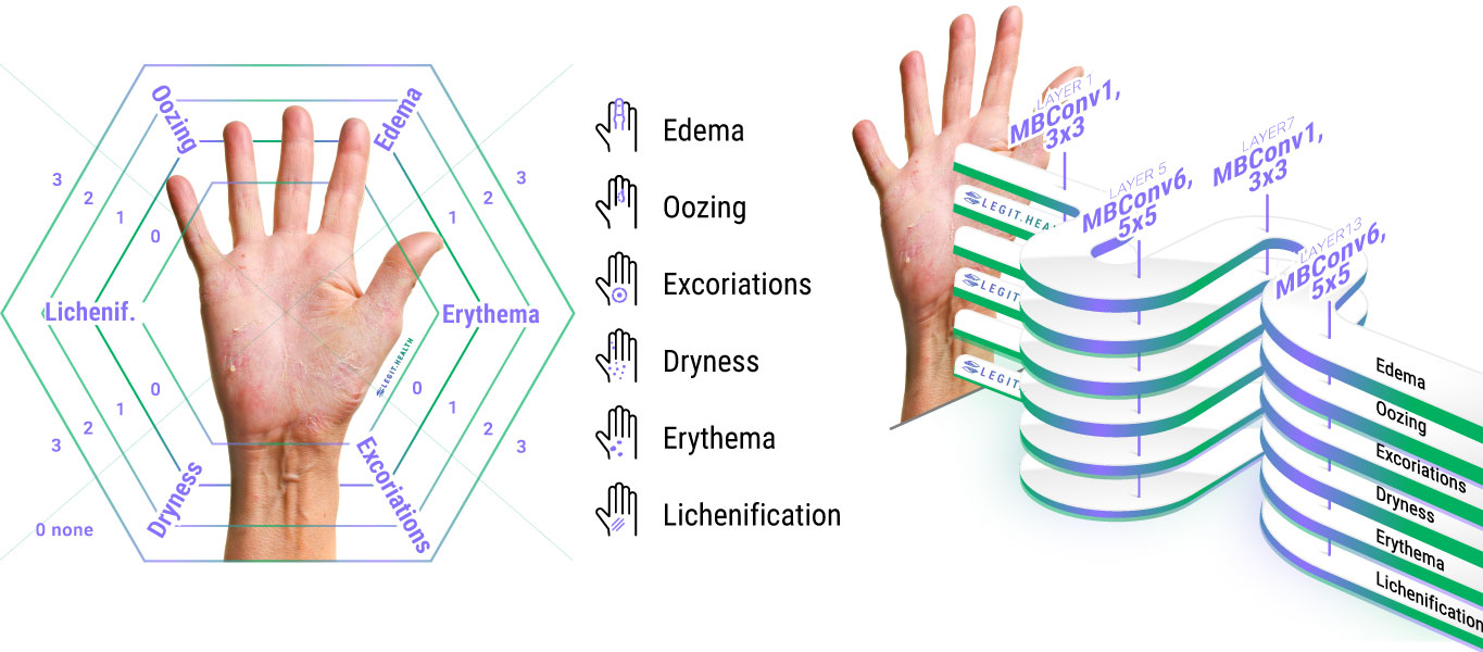 Infographic of the automatic dermatitis and eczema scoring system