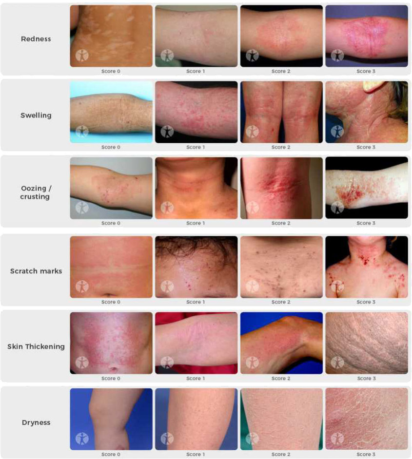 Diferencia entre eczema severo y leve